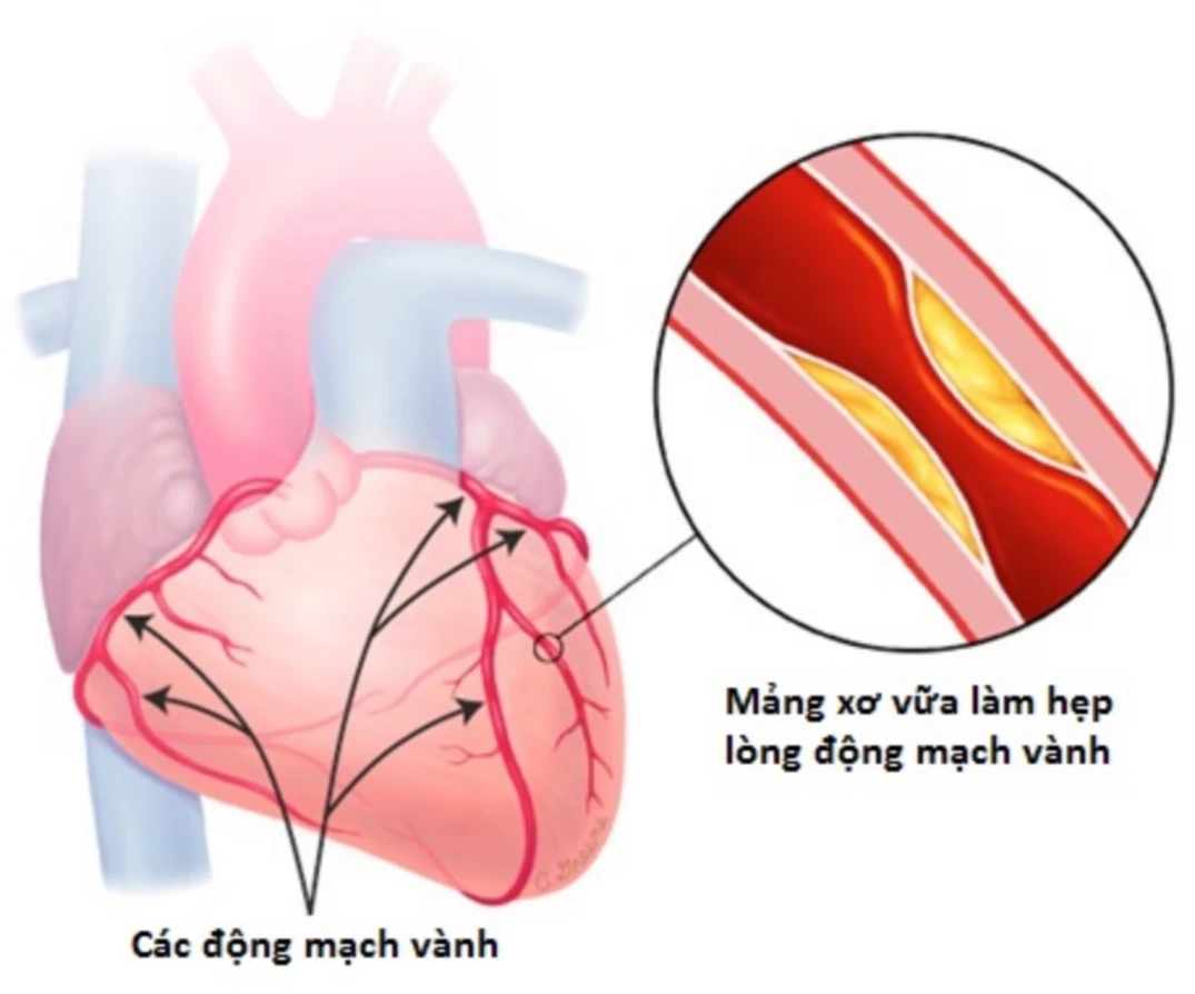 Các điều cần chú ý sau khi đặt stent động mạch vành